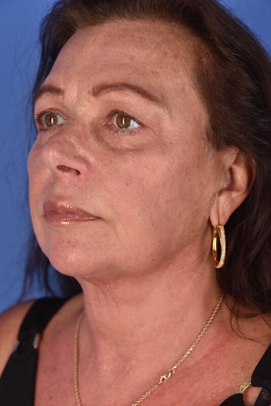 Neck Lift Before & After Image