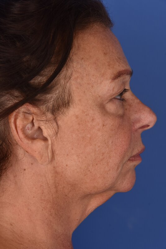 Neck Lift Before & After Image