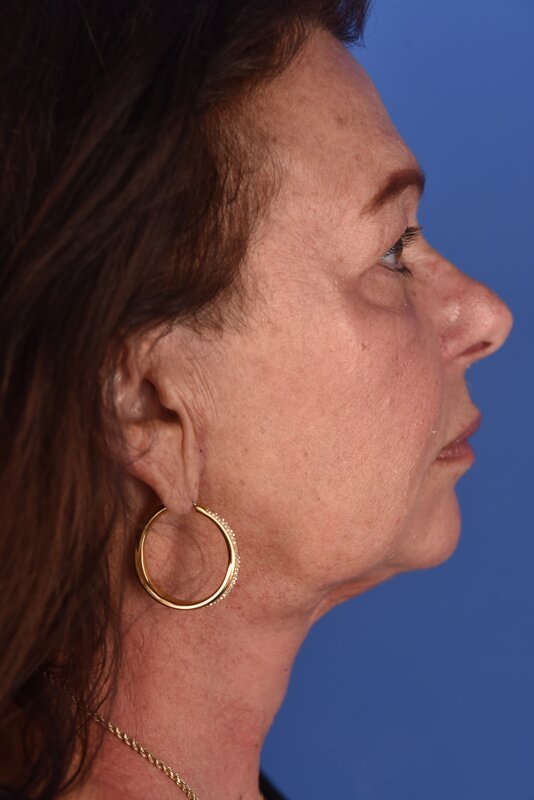 Neck Lift Before & After Image