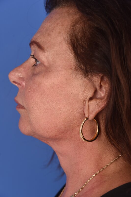 Neck Lift Before & After Image