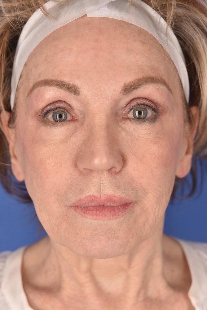 Neck Lift Before & After Image