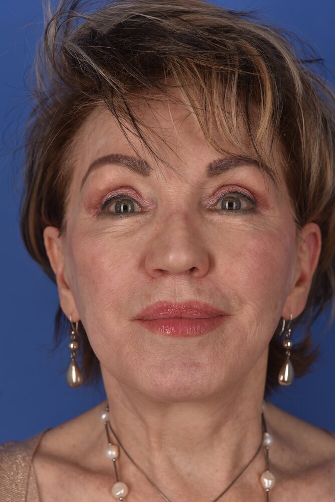 Neck Lift Before & After Image