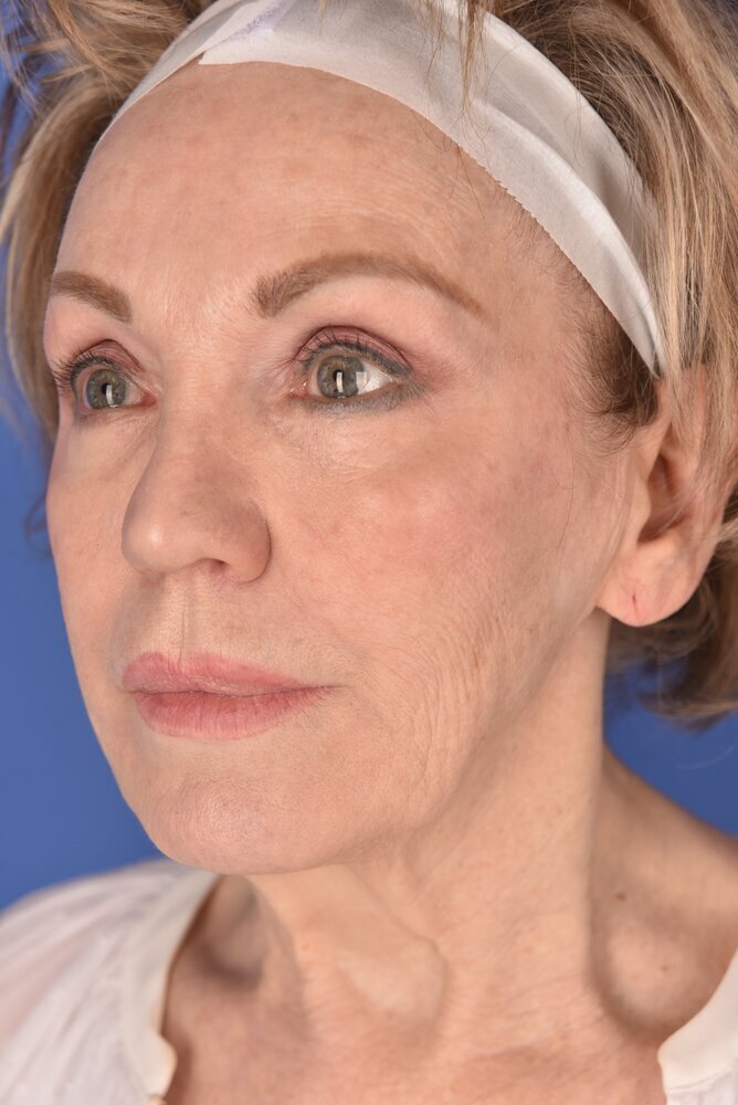 Neck Lift Before & After Image