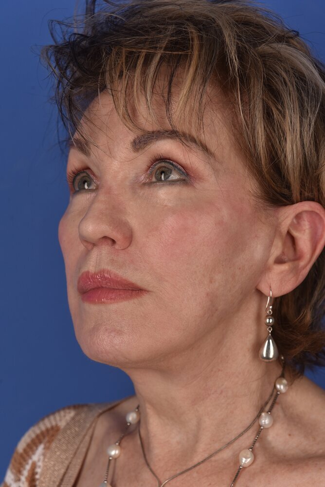 Neck Lift Before & After Image