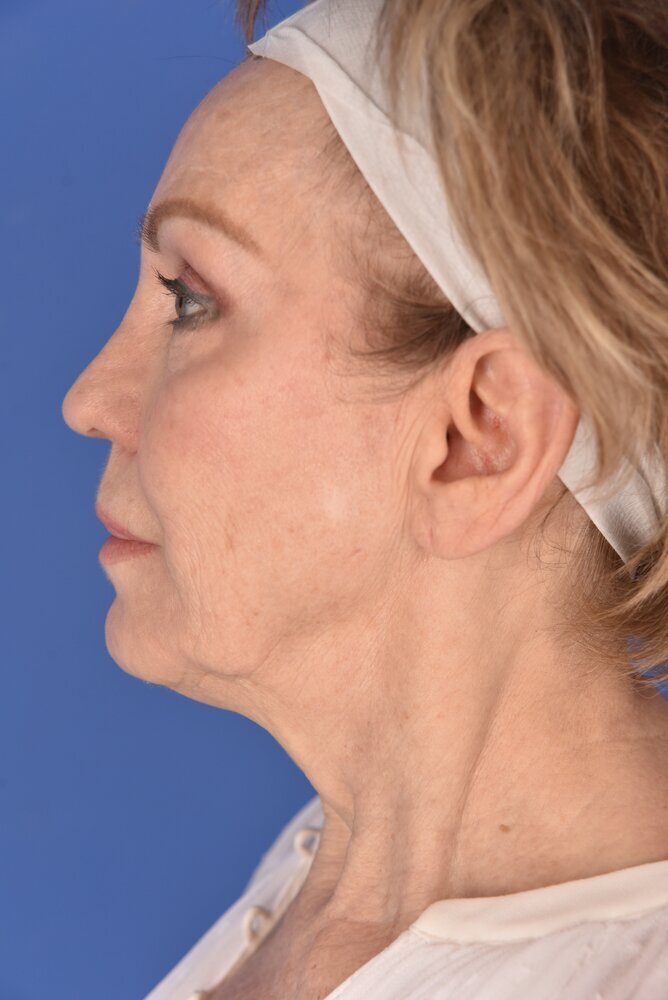Neck Lift Before & After Image