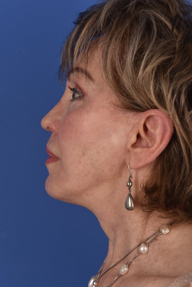 Neck Lift Before & After Image