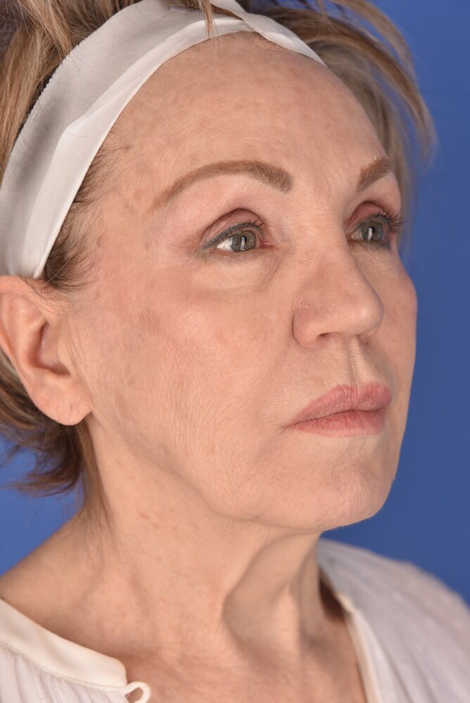 Neck Lift Before & After Image