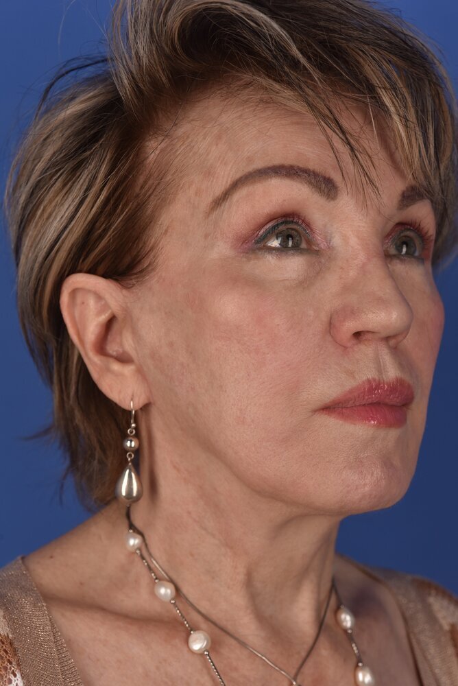 Neck Lift Before & After Image