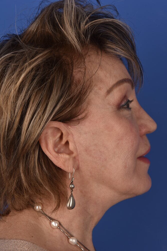 Neck Lift Before & After Image