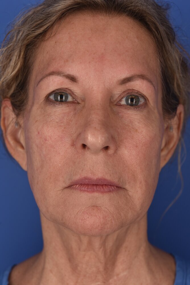 Neck Lift Before & After Image