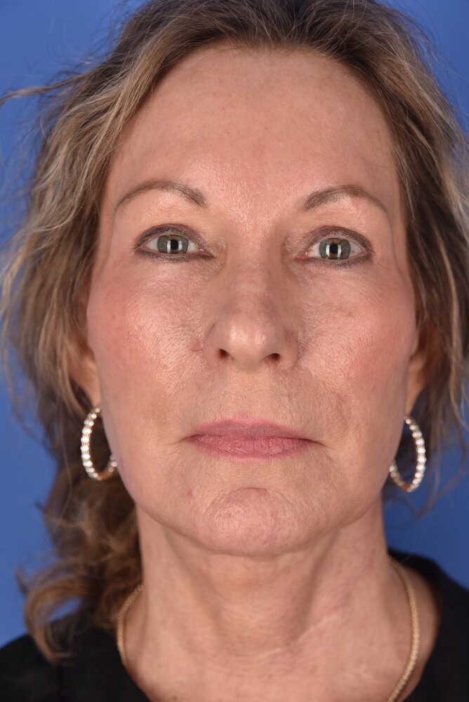 Neck Lift Before & After Image