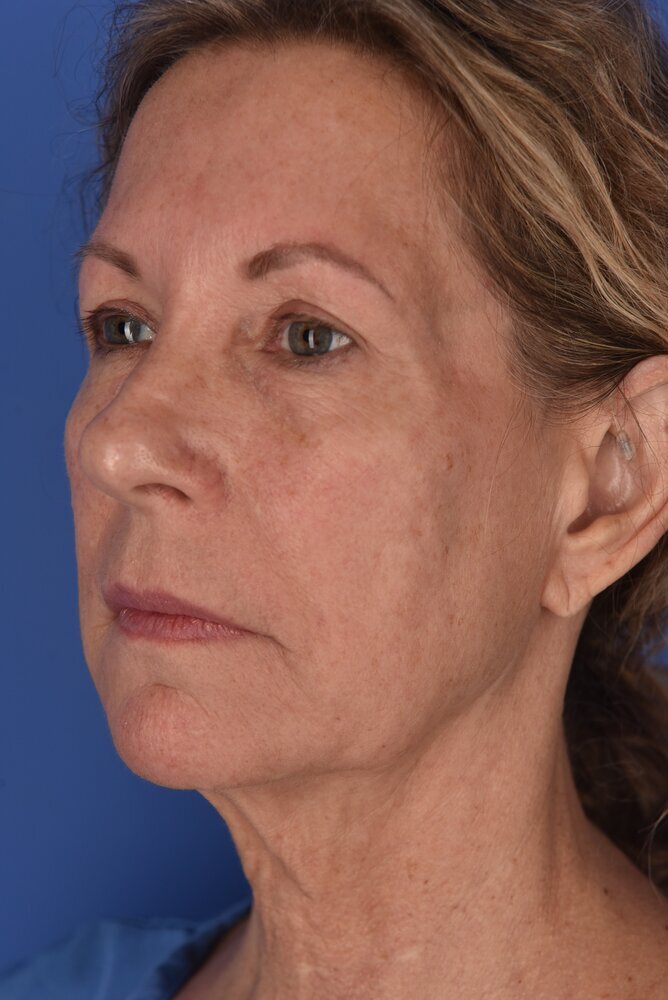 Neck Lift Before & After Image