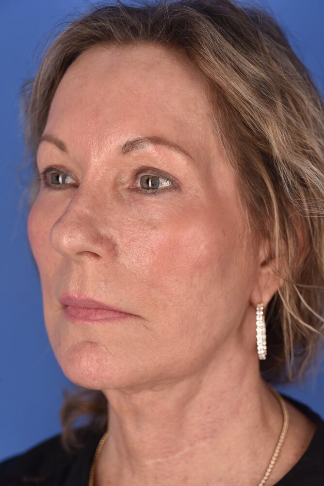 Neck Lift Before & After Image