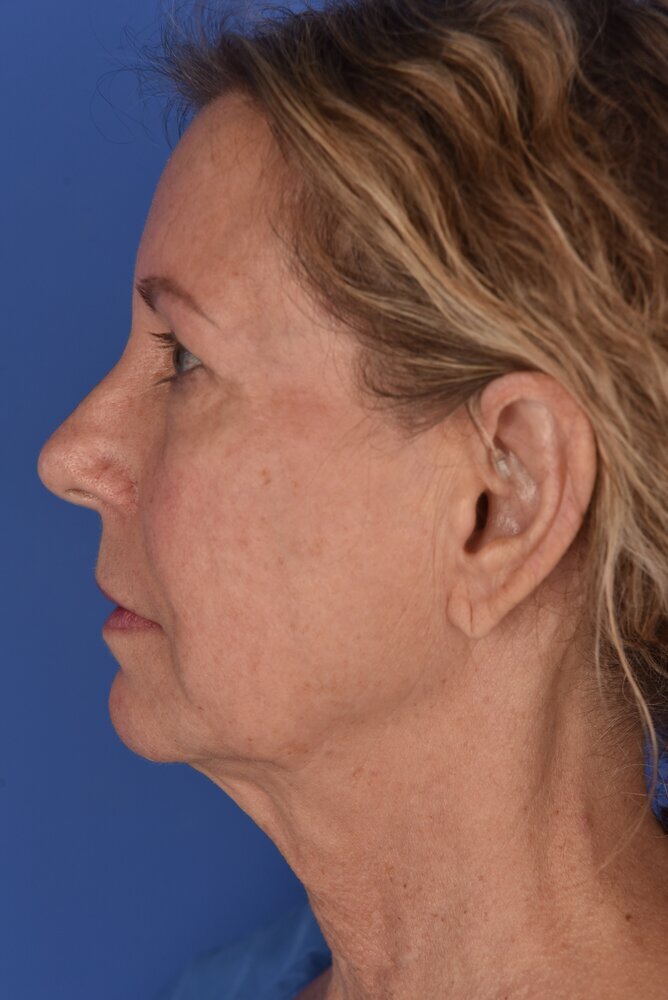 Neck Lift Before & After Image