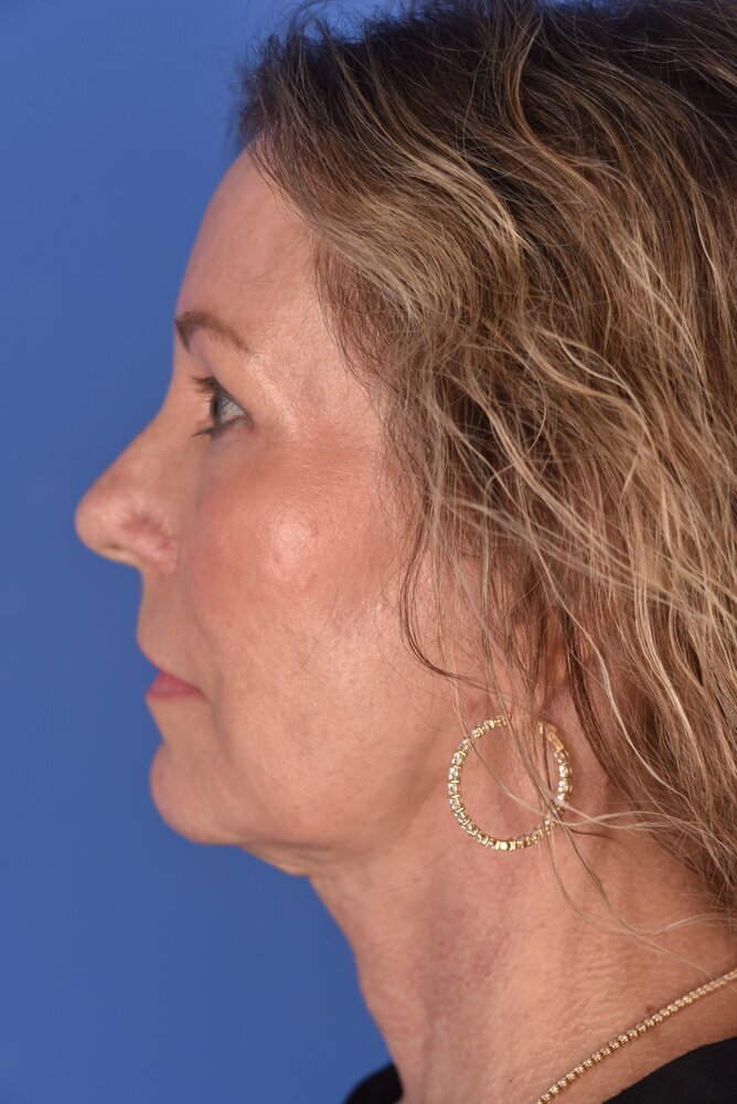 Neck Lift Before & After Image