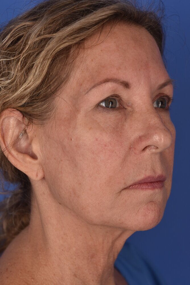 Neck Lift Before & After Image