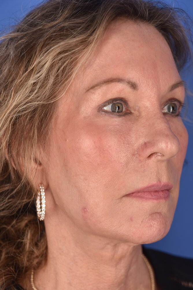 Neck Lift Before & After Image