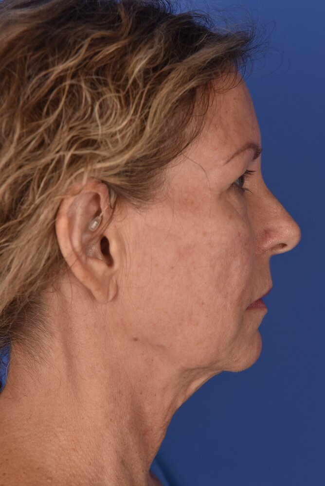 Neck Lift Before & After Image
