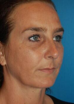 Rhinoplasty Before & After Image