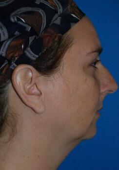 Rhinoplasty Before & After Image