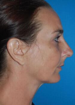 Rhinoplasty Before & After Image