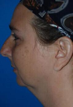 Rhinoplasty Before & After Image