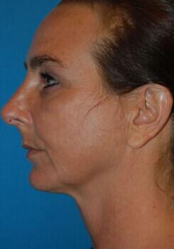 Rhinoplasty Before & After Image