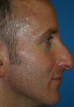 Rhinoplasty Before & After Image