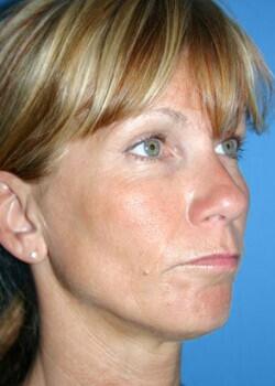 Rhinoplasty Before & After Image