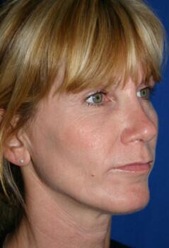 Rhinoplasty Before & After Image