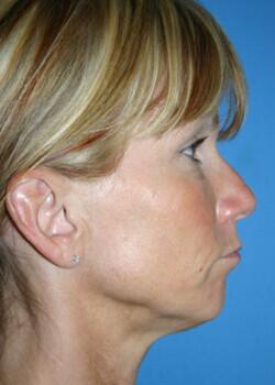 Rhinoplasty Before & After Image