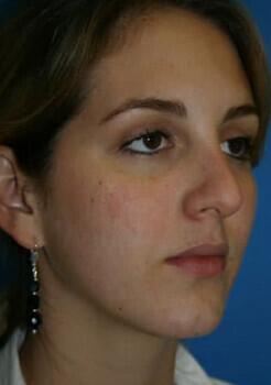 Rhinoplasty Before & After Image