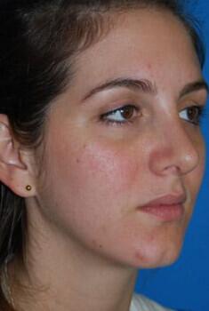 Rhinoplasty Before & After Image