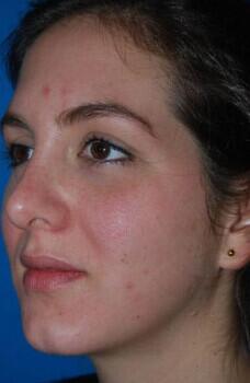 Rhinoplasty Before & After Image