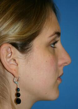 Rhinoplasty Before & After Image