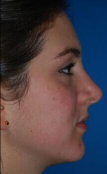 Rhinoplasty Before & After Image