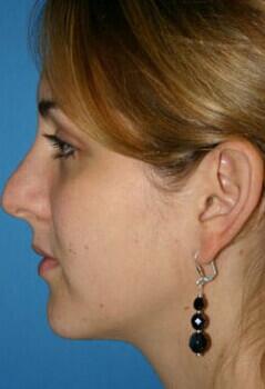 Rhinoplasty Before & After Image