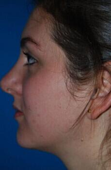 Rhinoplasty Before & After Image