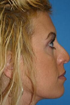 Rhinoplasty Before & After Image