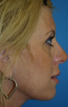 Rhinoplasty Before & After Image