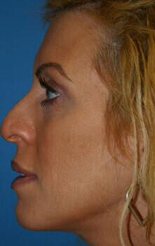 Rhinoplasty Before & After Image