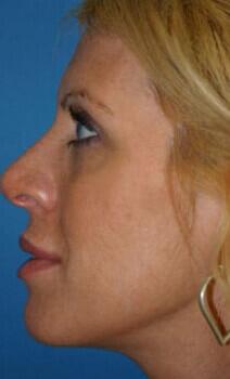 Rhinoplasty Before & After Image