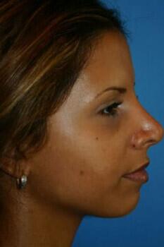 Rhinoplasty Before & After Image