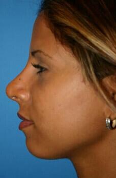 Rhinoplasty Before & After Image