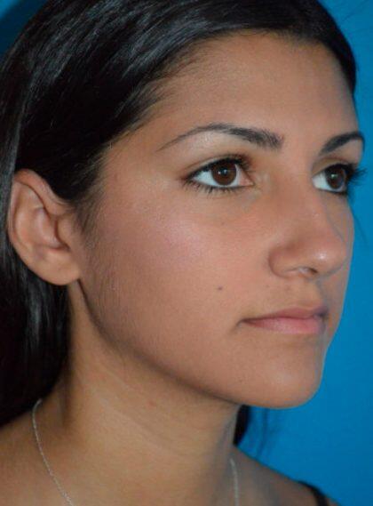 Rhinoplasty Before & After Image