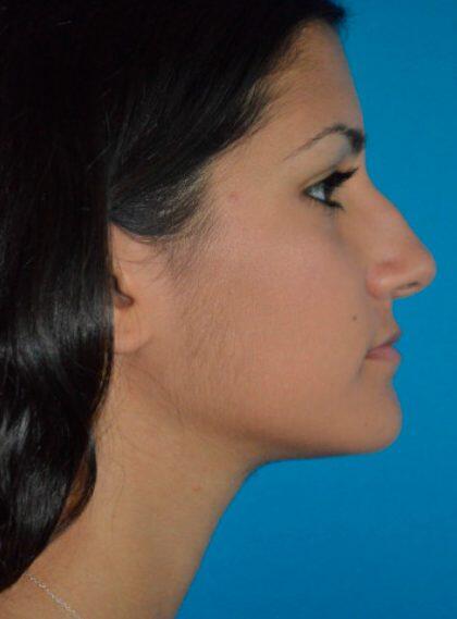 Rhinoplasty Before & After Image