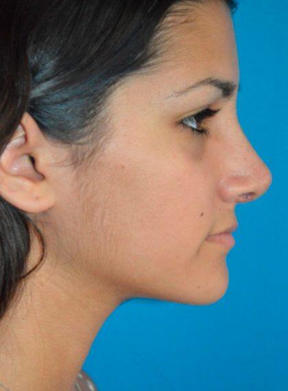 Rhinoplasty Before & After Image