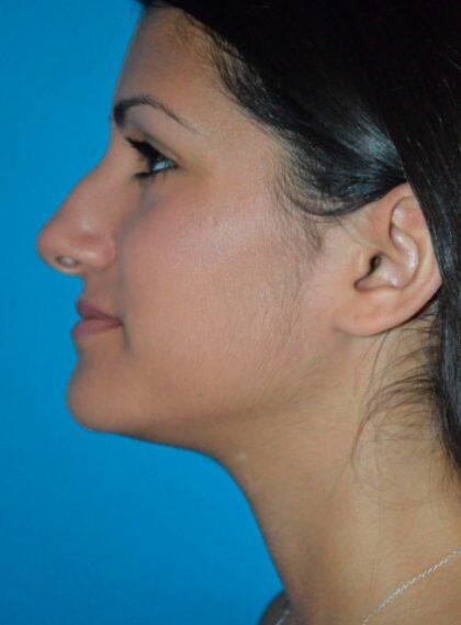 Rhinoplasty Before & After Image