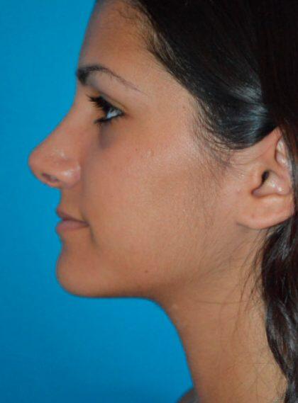 Rhinoplasty Before & After Image