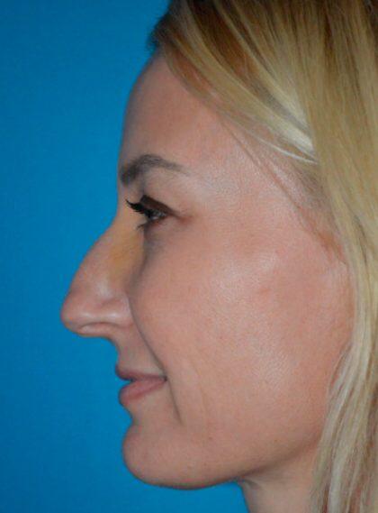 Rhinoplasty Before & After Image